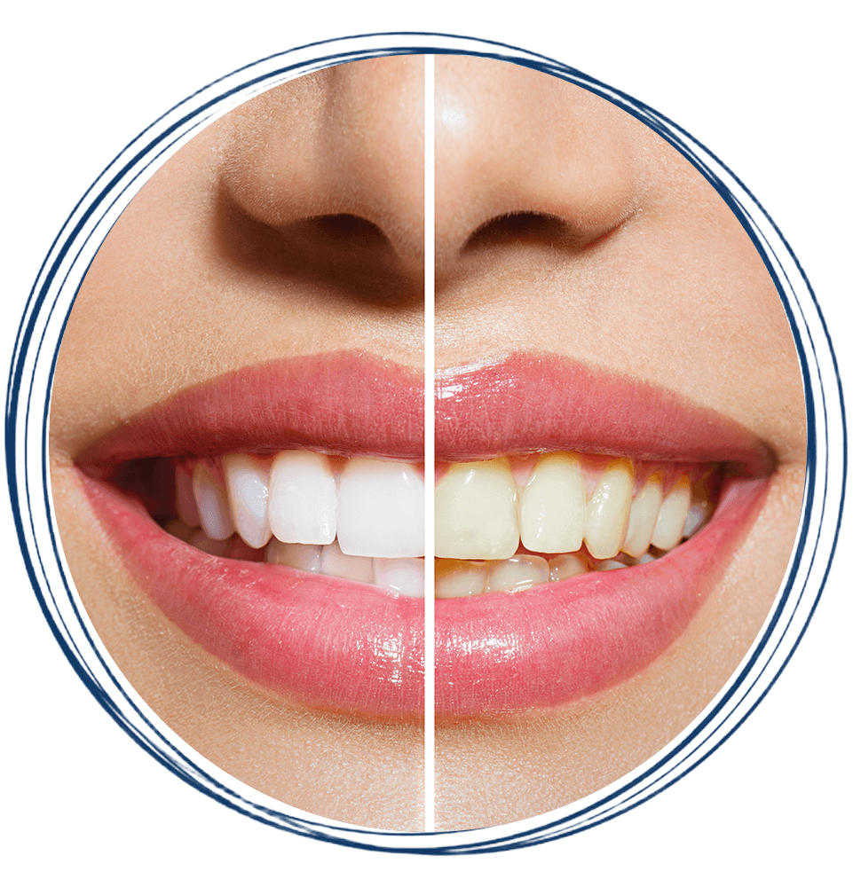 before after tooth whitening