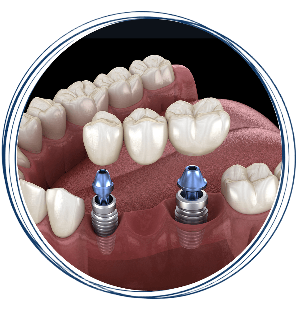 implant bridge 3d