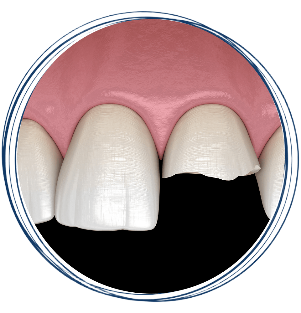 chip tooth 3d