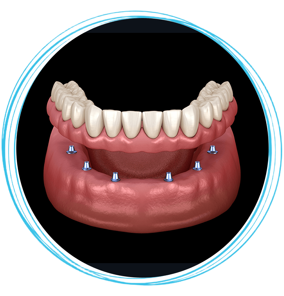 implant denture