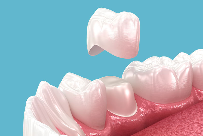 dental crown 3d