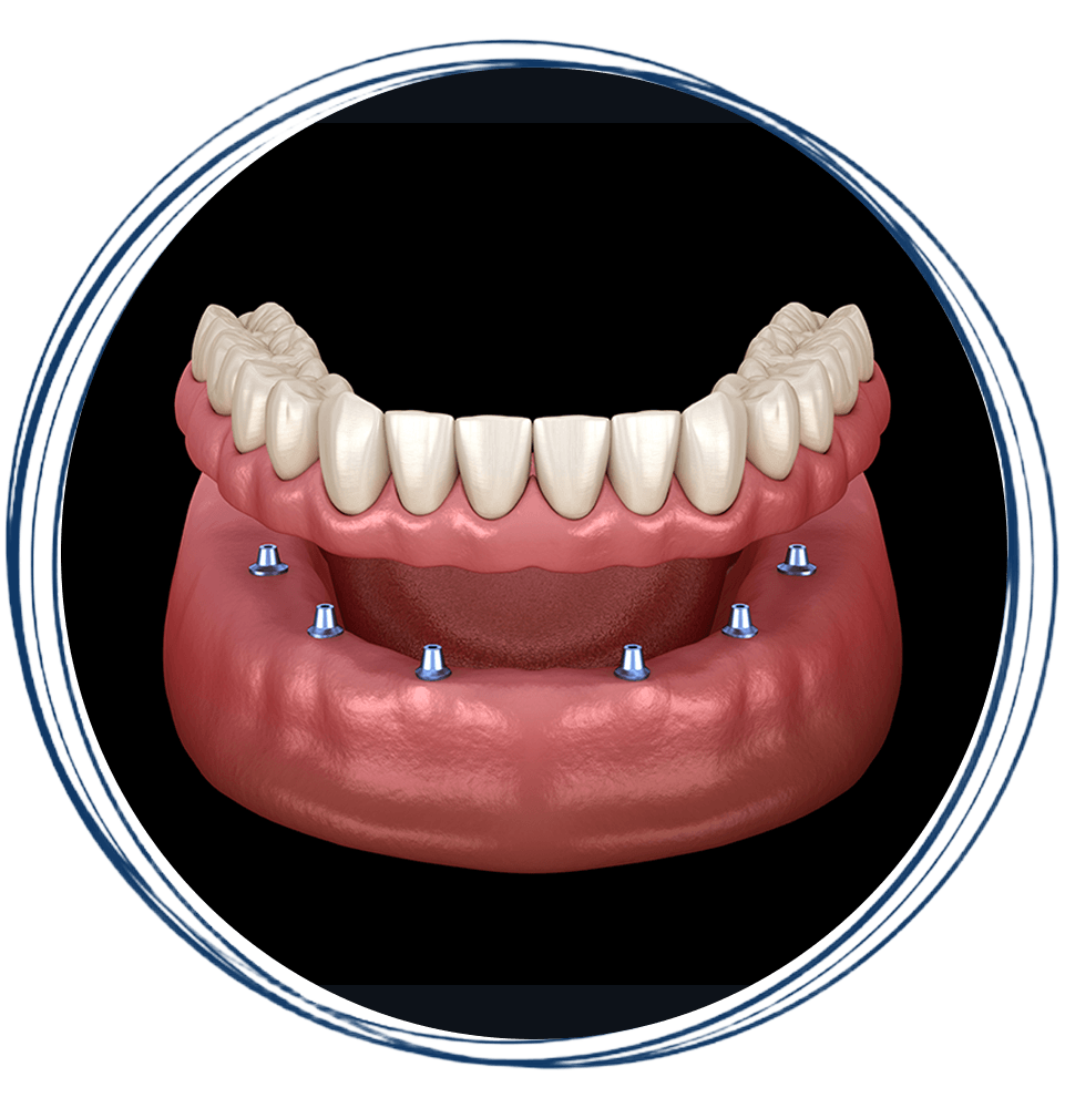 implant dentures 3d