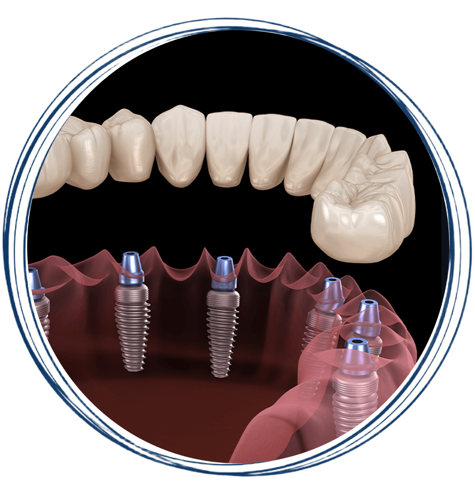 full mouth dental implants 3d