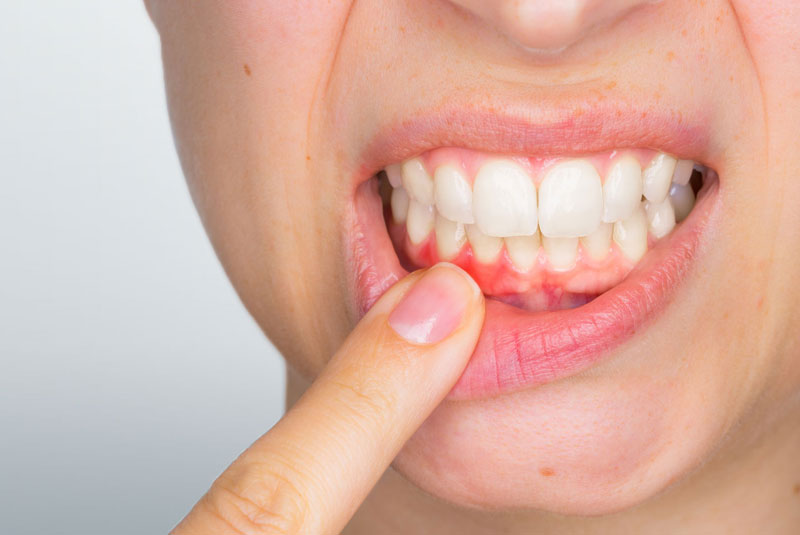 gum disease symptoms