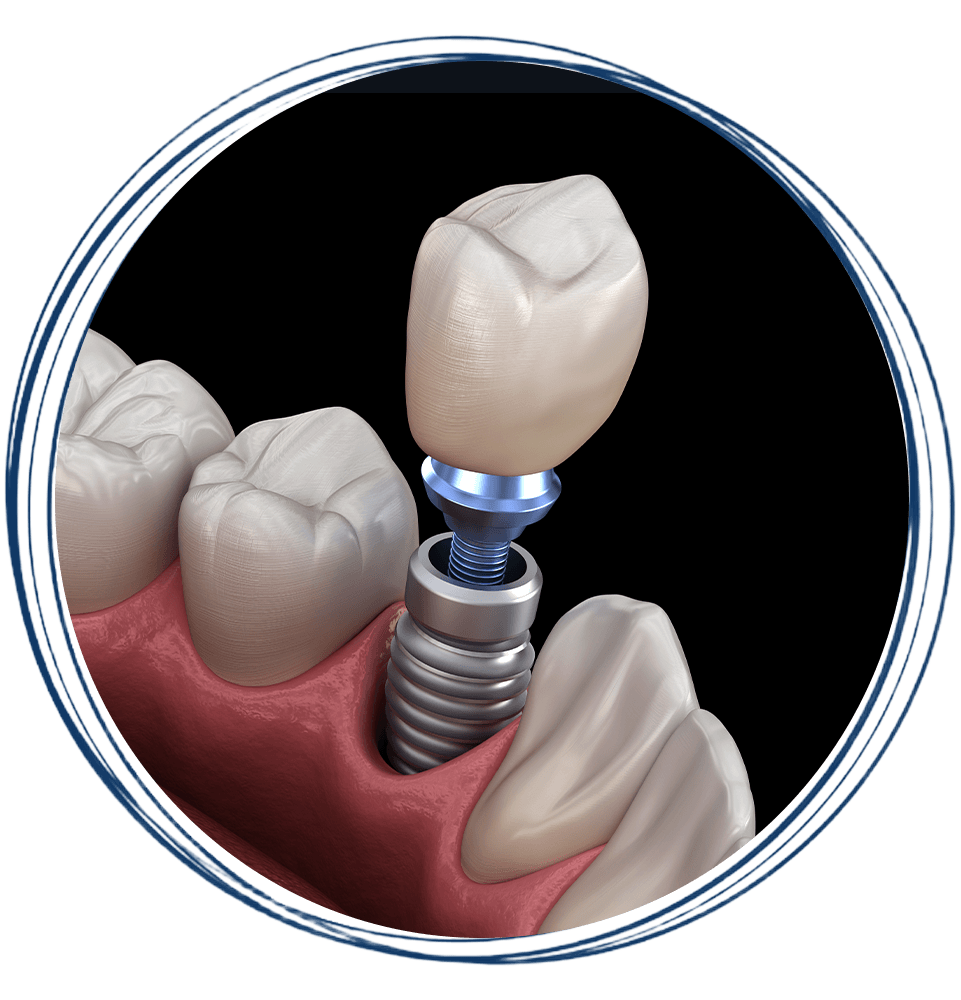 implant model 3d