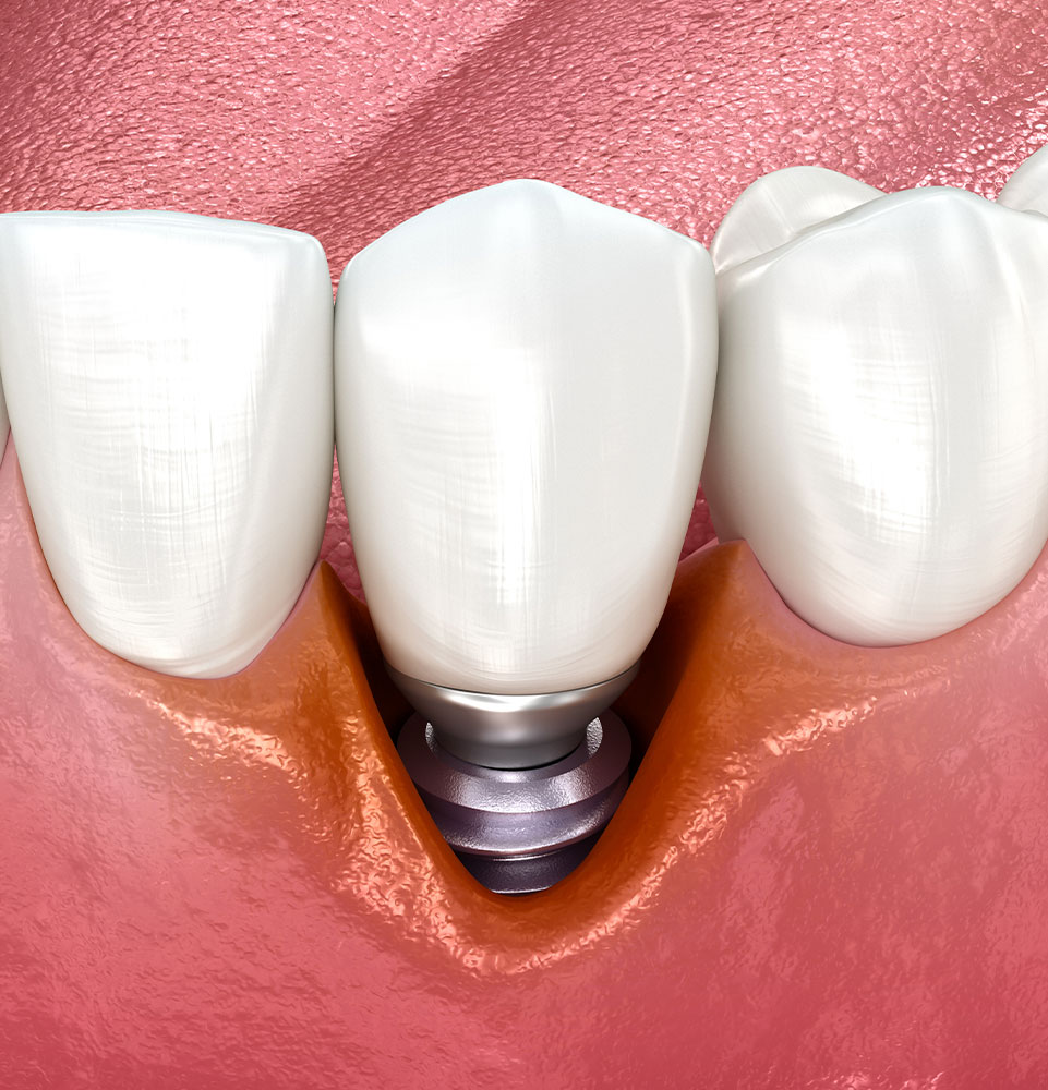 implant failing